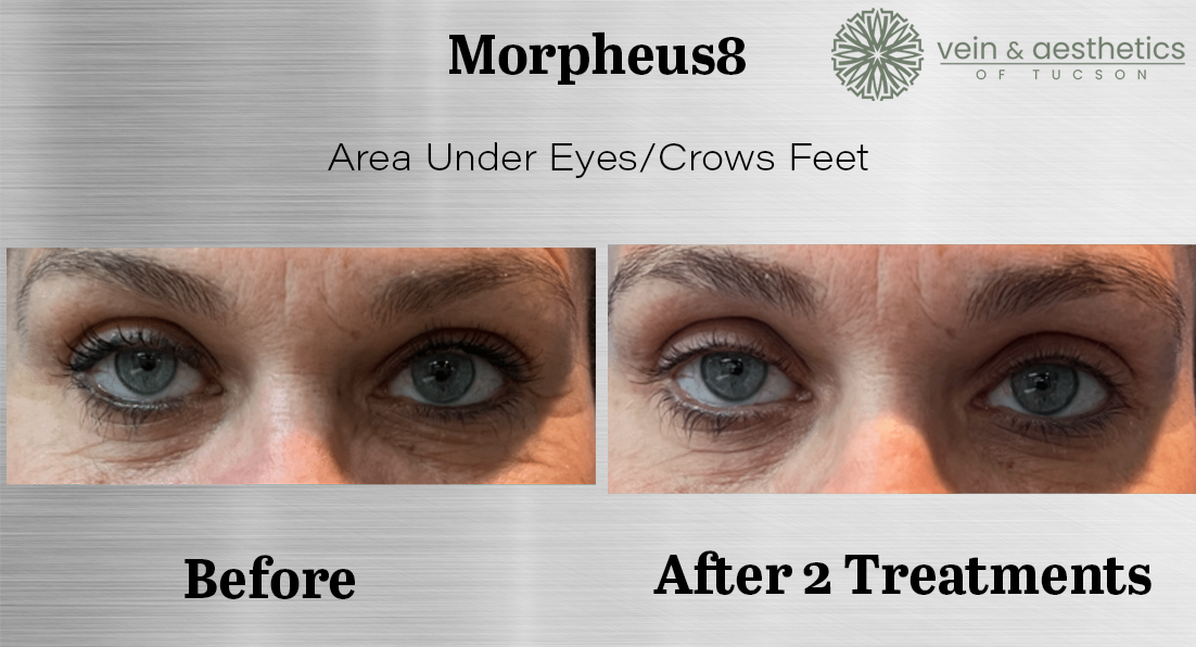 under eyes